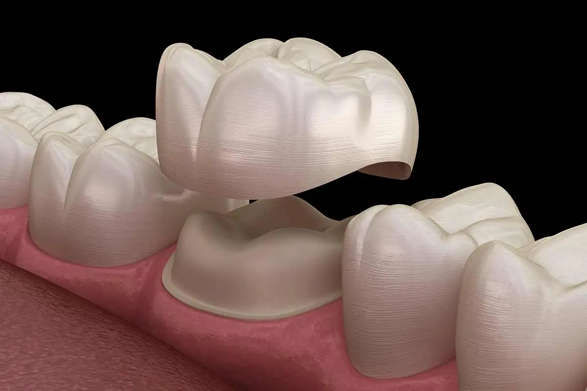 dental crowns available at Scottsdale Dental Arts