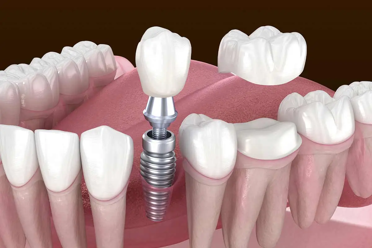 diagram showing how dental implants are placed